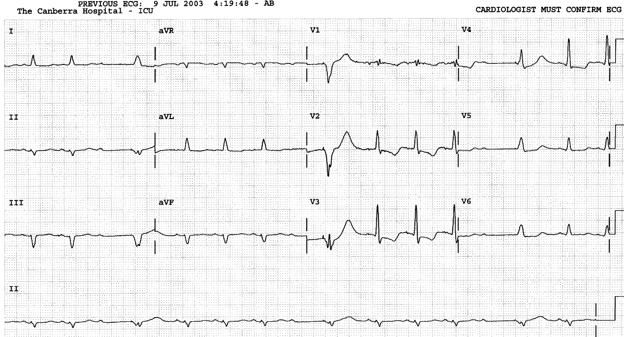 Pacemaker escape beats are easier to recognise.