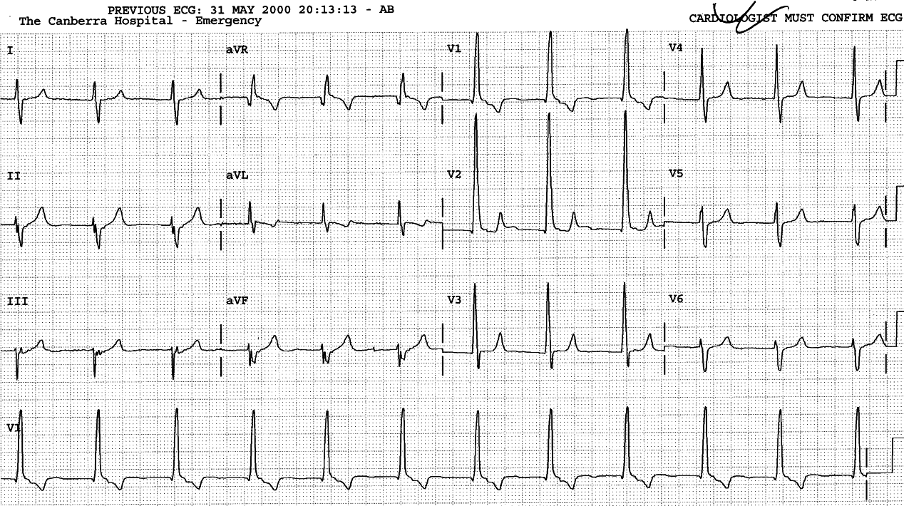 Junctional rhythm 69/min.