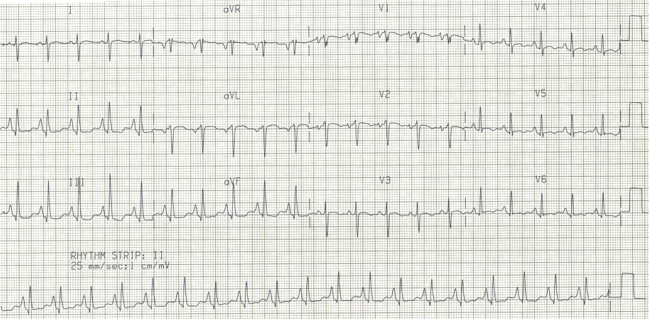 51 year old lady with COAD