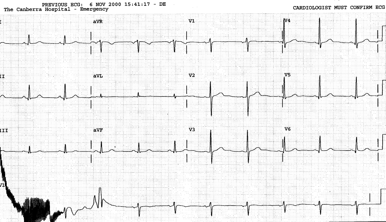 This patientâs ECGs appear dogged by technical problems.