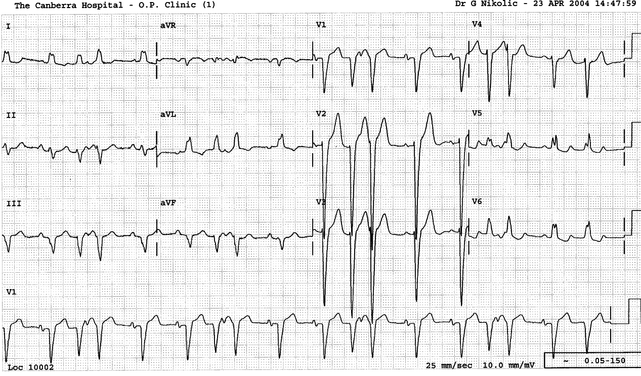 79 year old lady with chronic coronary artery disease     and increasing angina.  