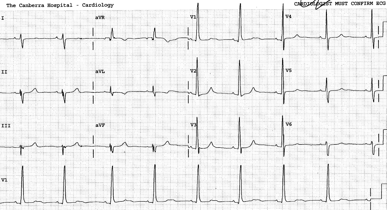 Sinus bradycardia 51/min.