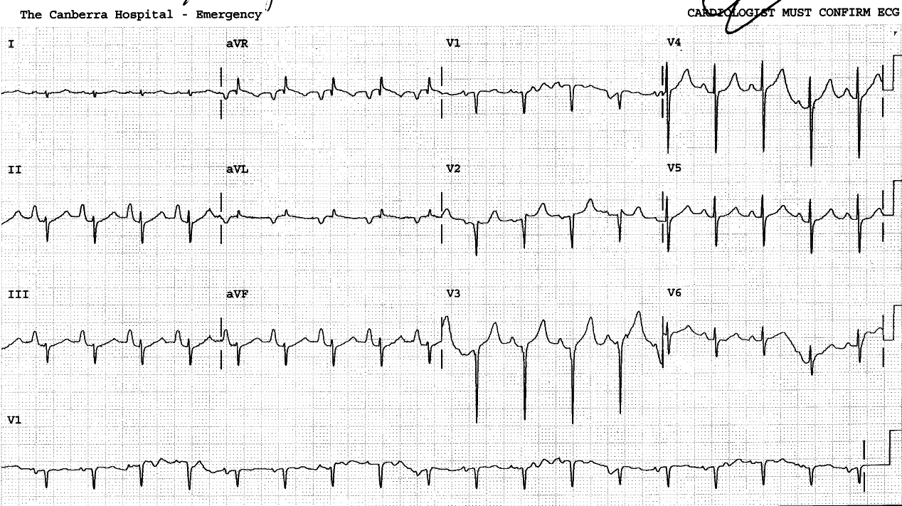 73 year old lady with emphysema