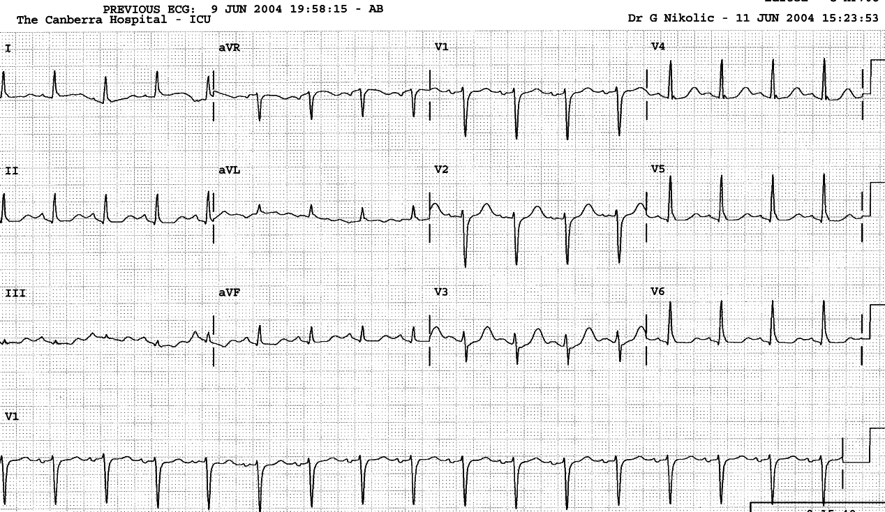 55 year old lady ventilated after out-of-hospital cardiac arrest