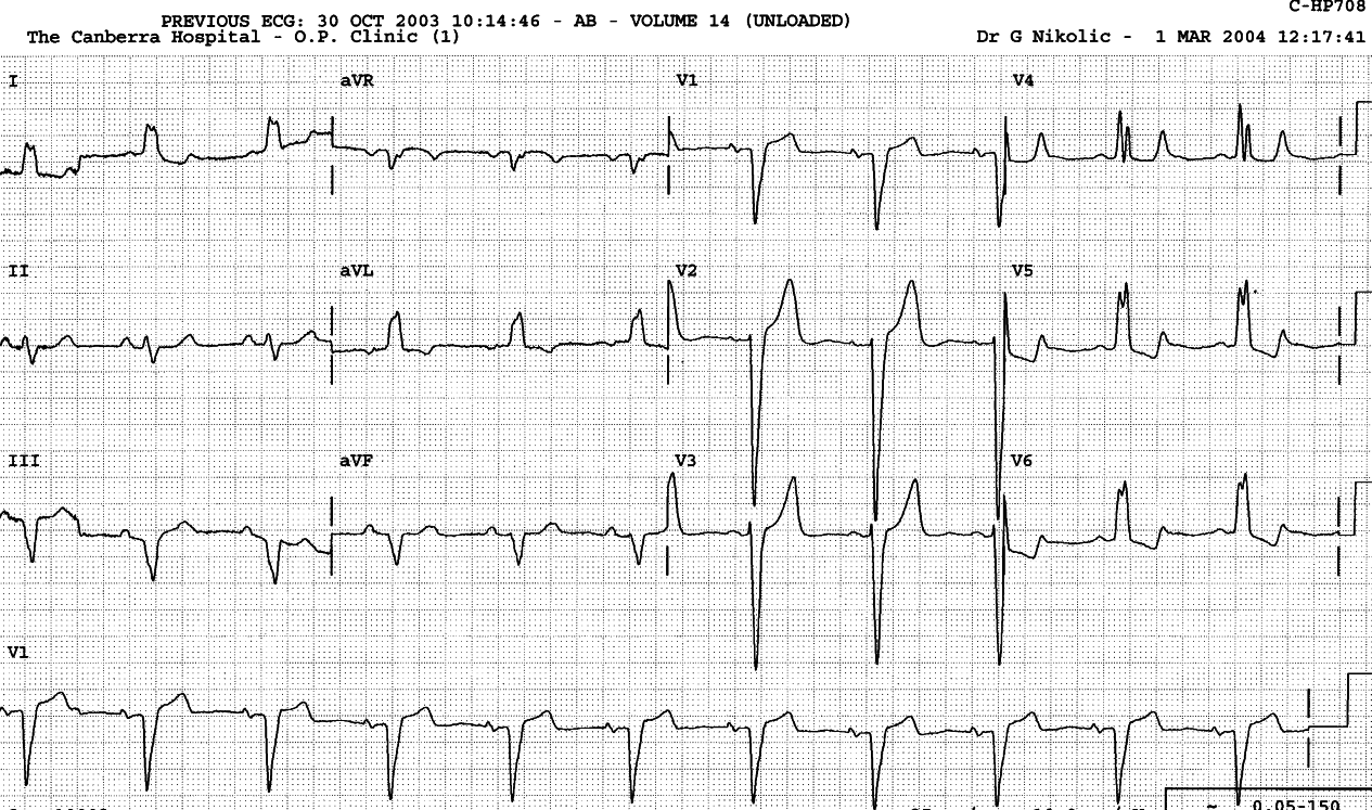 Persistent primary T wave changes. 