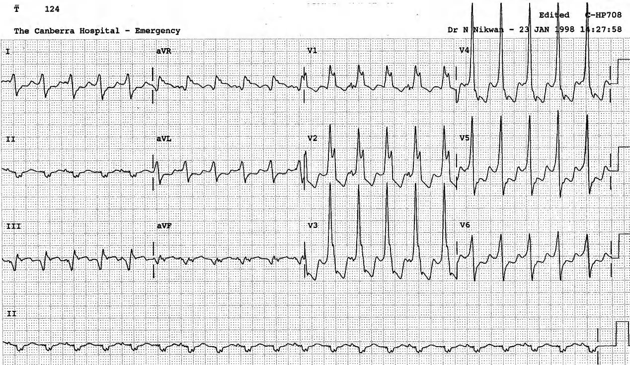 Intubated 73 year old man transferred from a peripheral hospital in cardiogenic shock following administration of sotalol, xylocaine and verapamil for broad-complex tachycardia. He had a large basal aneurysm from an old inferior infarction but no reversible ischÃ¦mia on thallium testing. He ended up transferred to another large hospital as our Intensive Care Unit was full. Eventually he received an ICD in Sydney. 