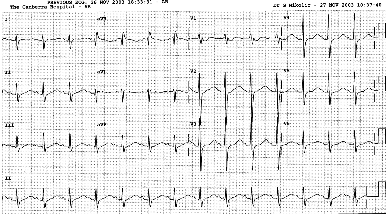 21 year old man with marked muscular weakness progressing over the past three days