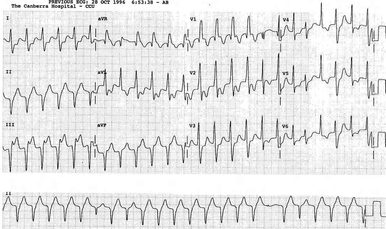 Fusion beats point to the diagnosis of VT. An SVT with VEBs could do the same. 