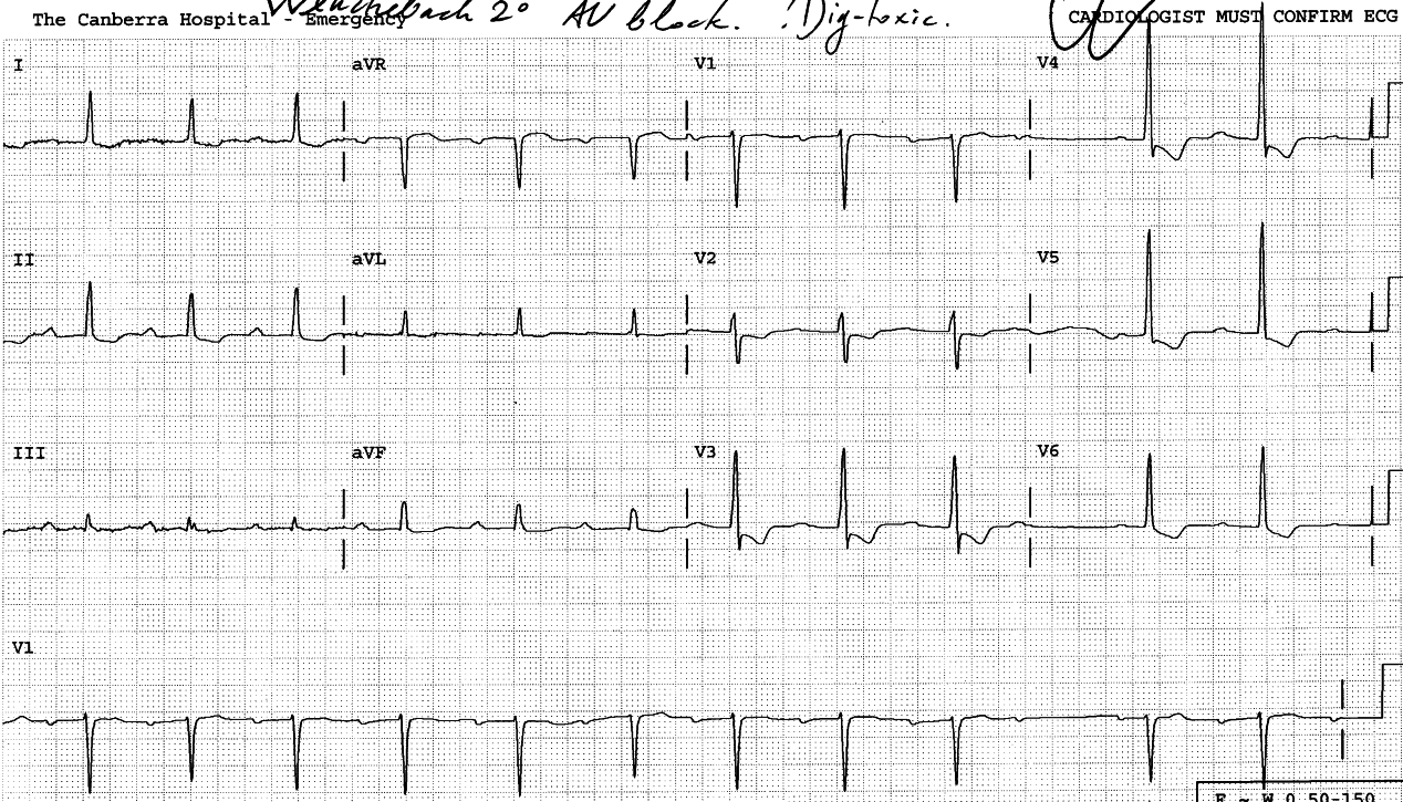 61 year old lady with congestive cardiomyopathy, on chronic digoxin therapy, sent home from Casualty following âvaso-vagalâ syncope