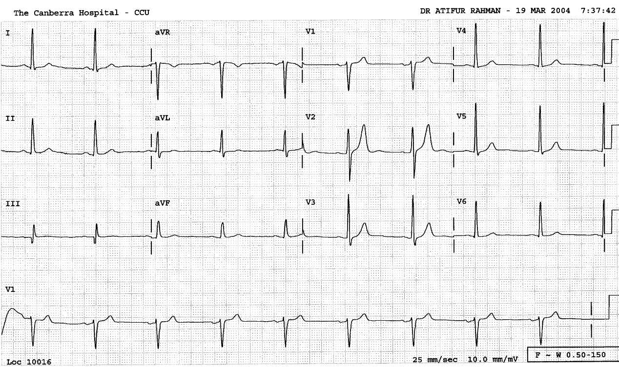 58 year old man with unstable angina.