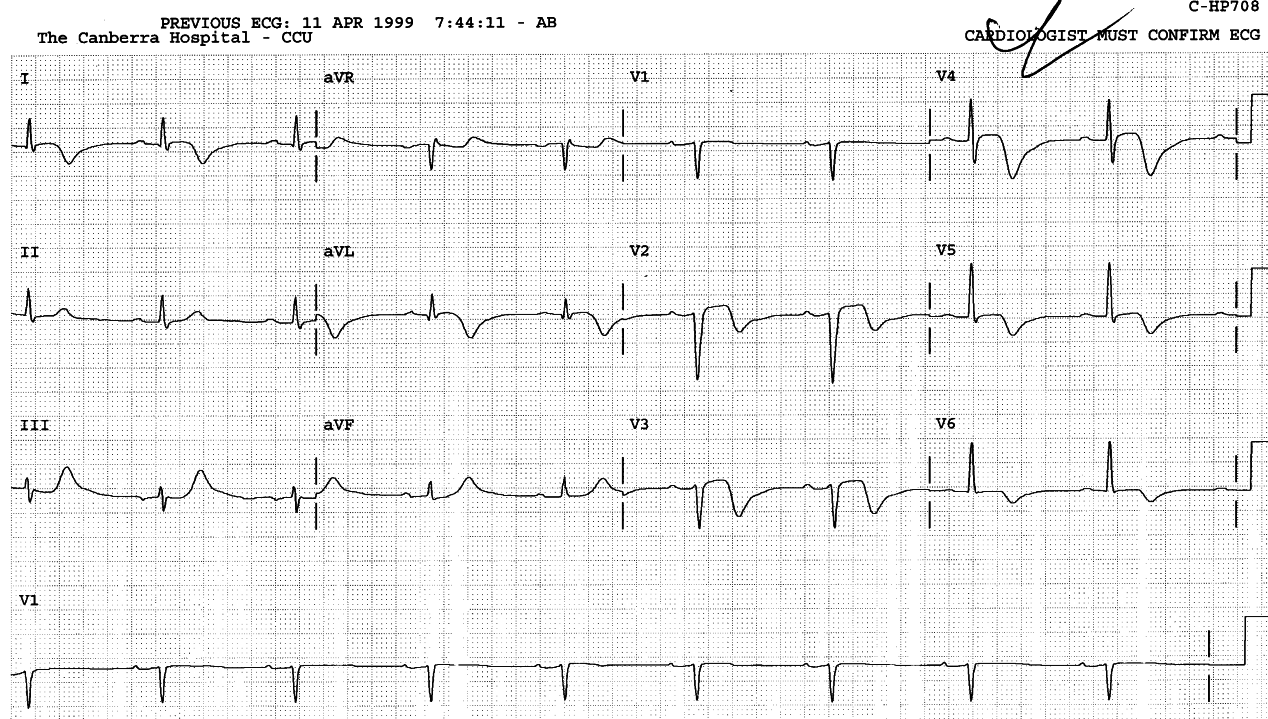 Reapperance of small anteroseptal R waves.