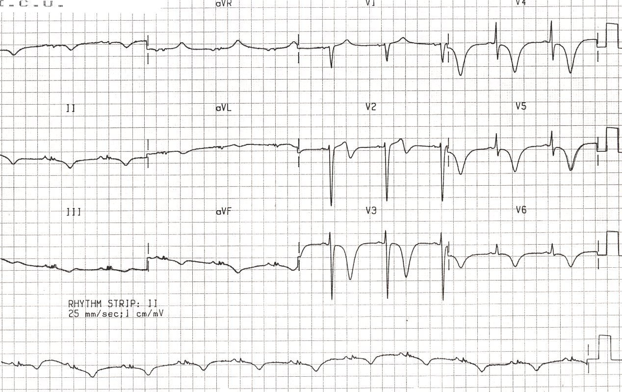 61 year old man with atypical chest pain and, apart from the ECGs, no subsequent evidence of heart disease.