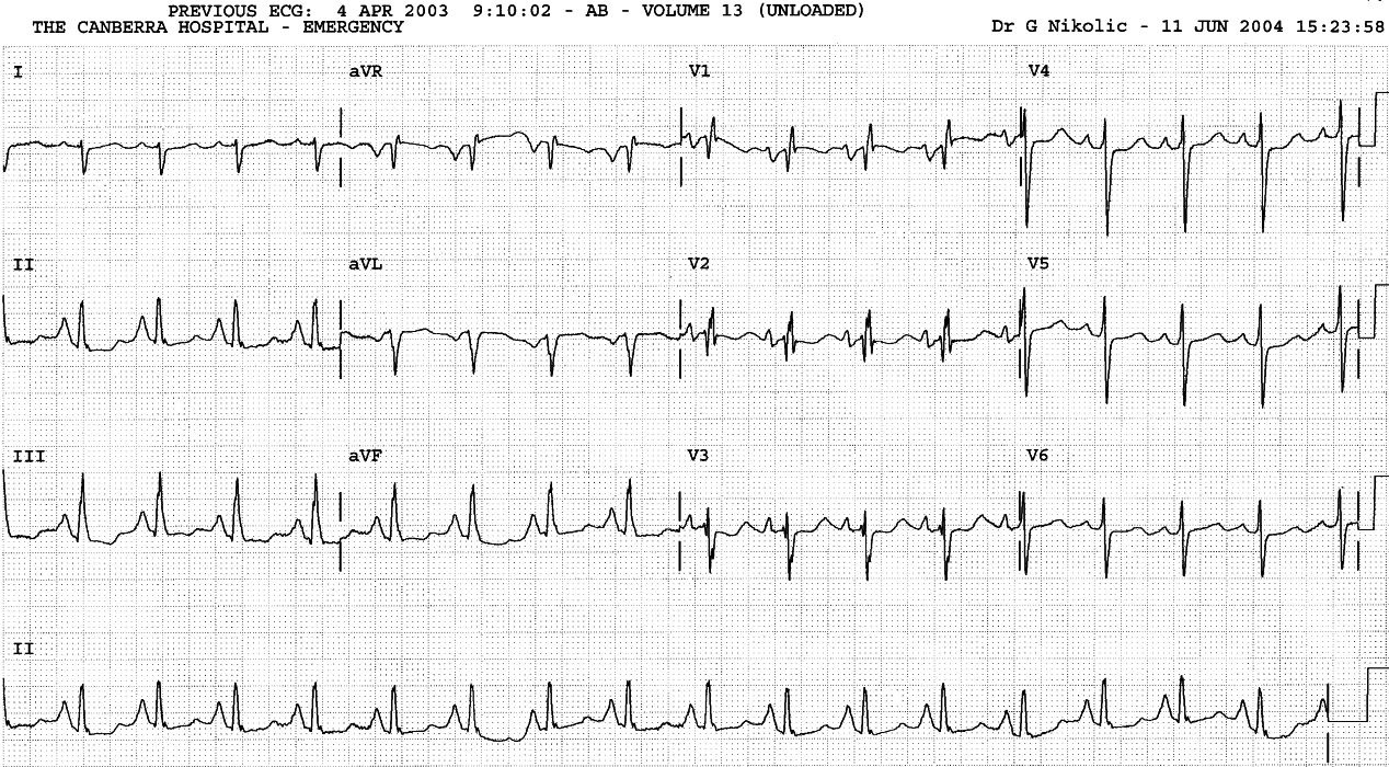 41 year old man with histiocytosis X