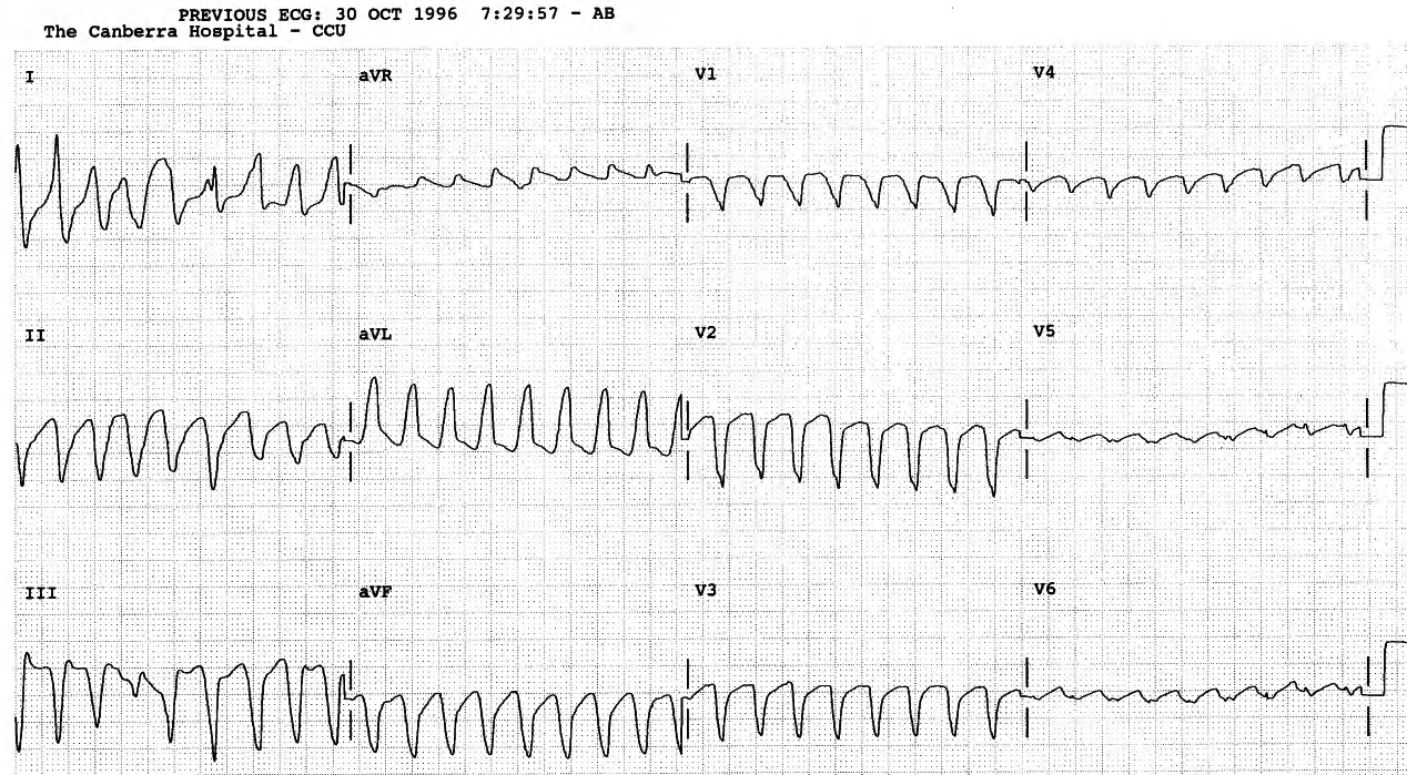 55 year old lady with angina and syncope. She also had a known old inferior wall infarction. 