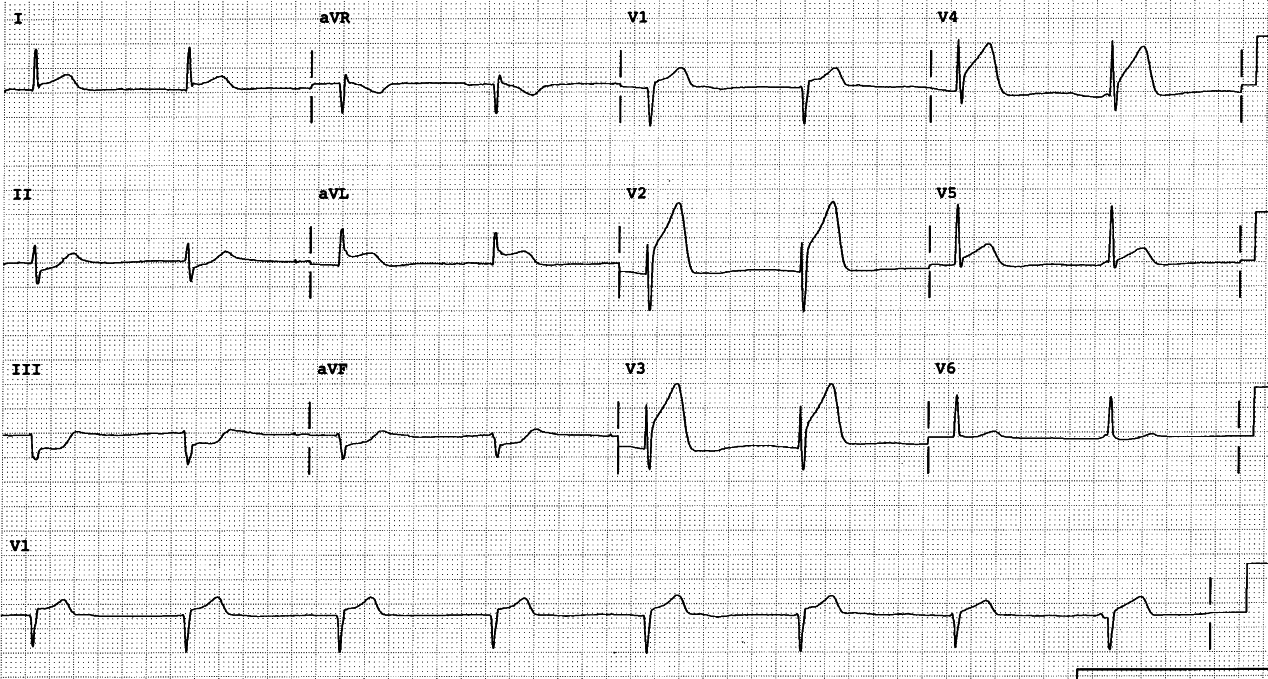 77 year old man with chest pain.