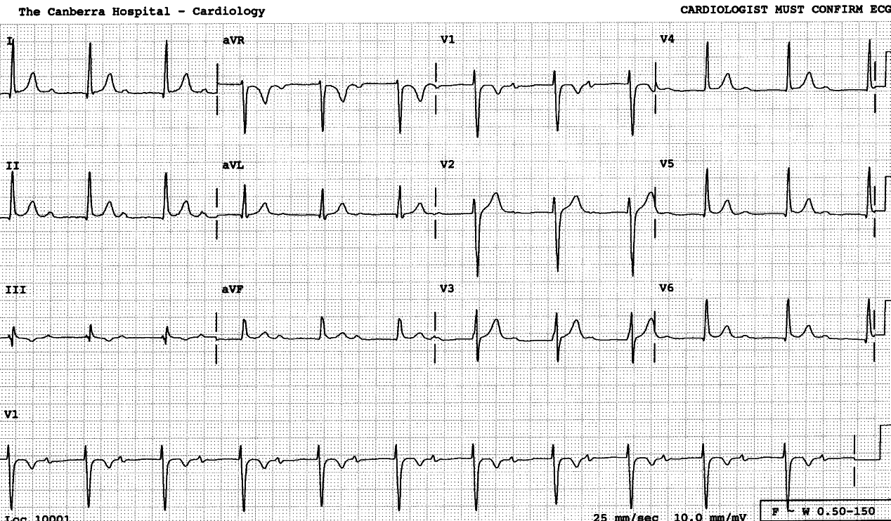 26 year old man with epilepsy, on, inter alia,     1g carbamazepine daily. 