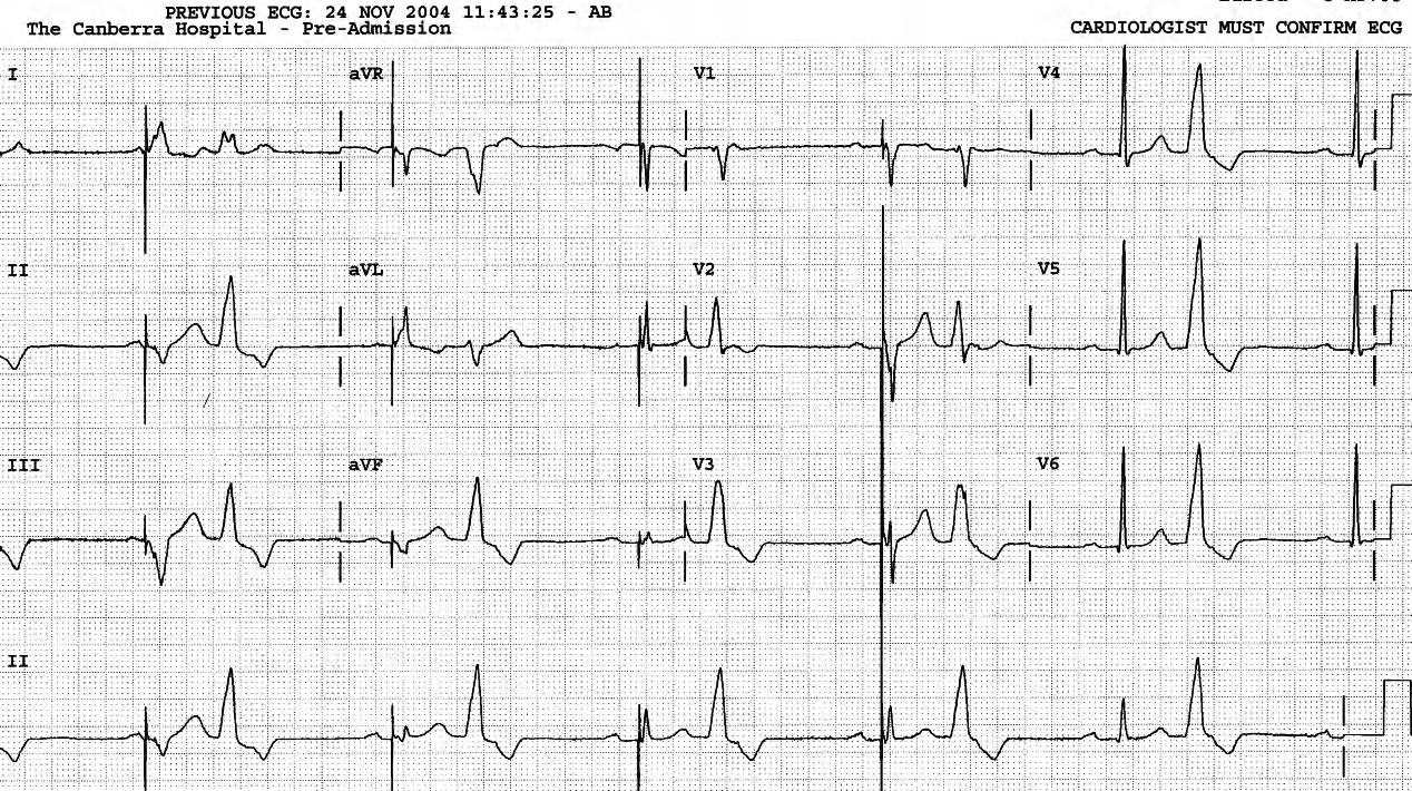 The blocked P waves distort the ST-T junction of the VEBs. The pacemaker is not sensing the atria; itâs escaping from the VEBs. 