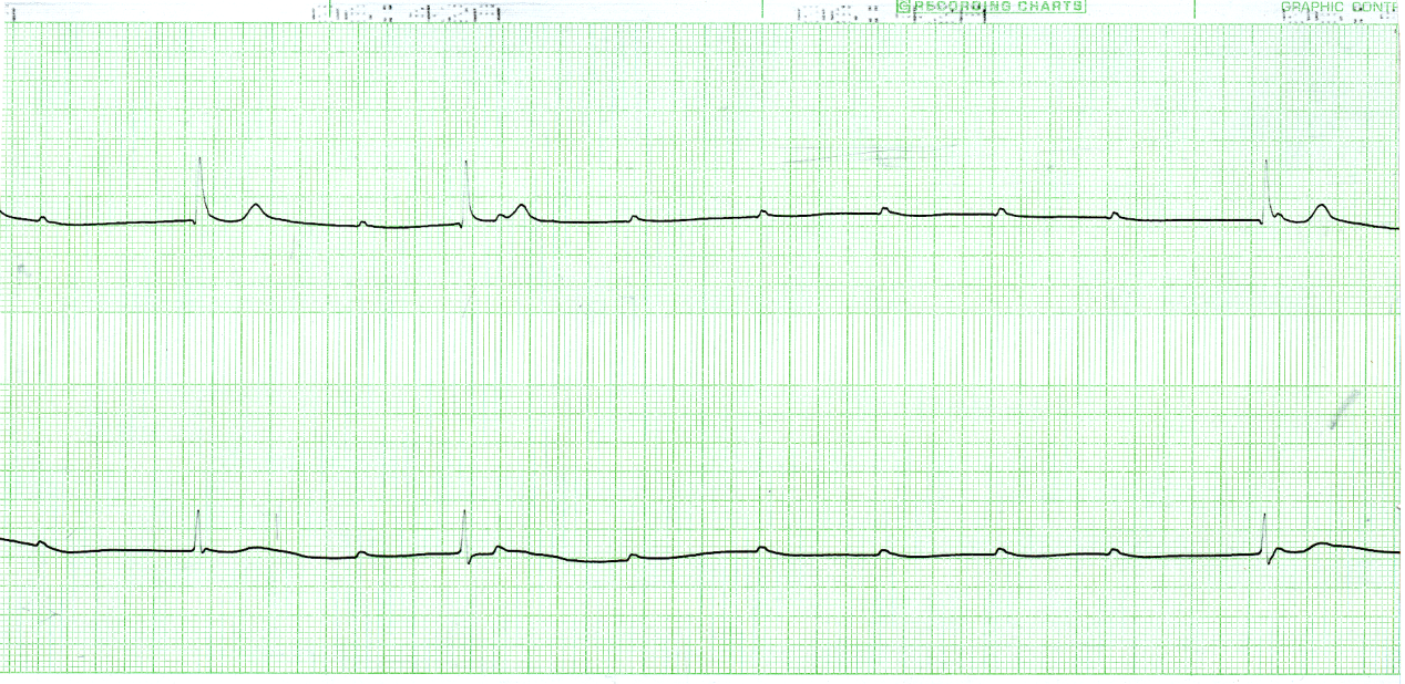 Holter monitor strip of an asymptomatic 20 year old woman with slow pulse since birth. 