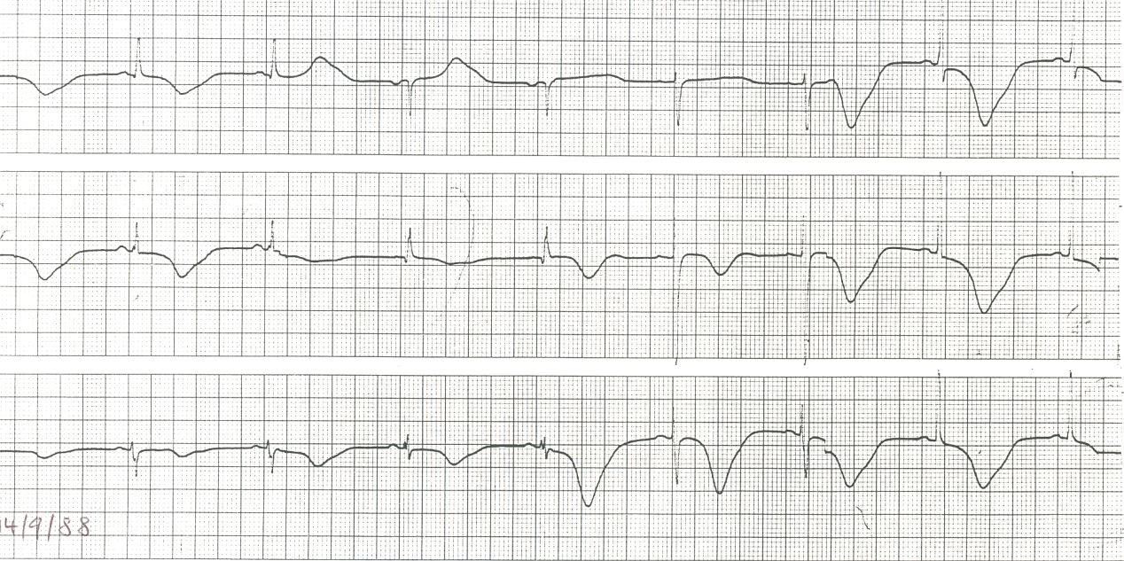 74 year old lady with pre-syncopal attack after taking one Anginine in her doctorâs surgery.