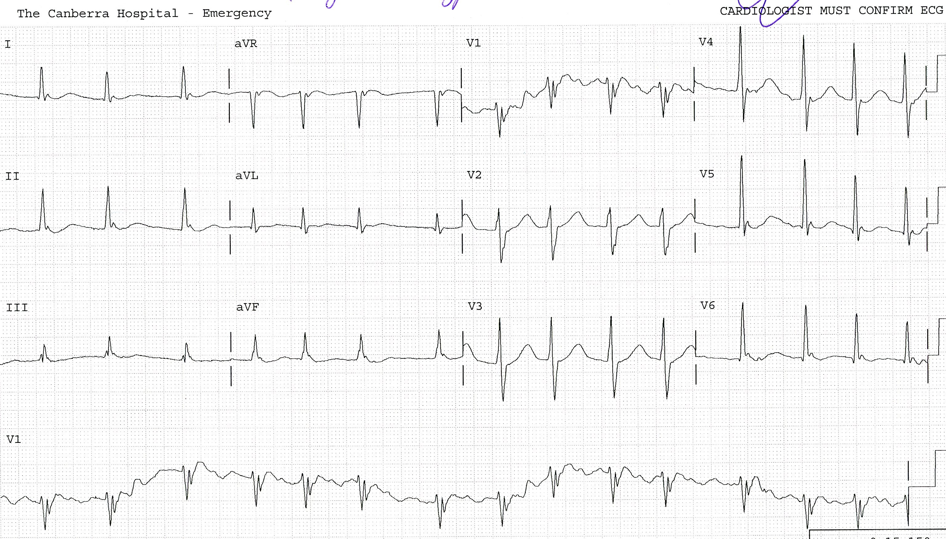 37 year old man ventilated after a polypharmacy and alcohol overdose