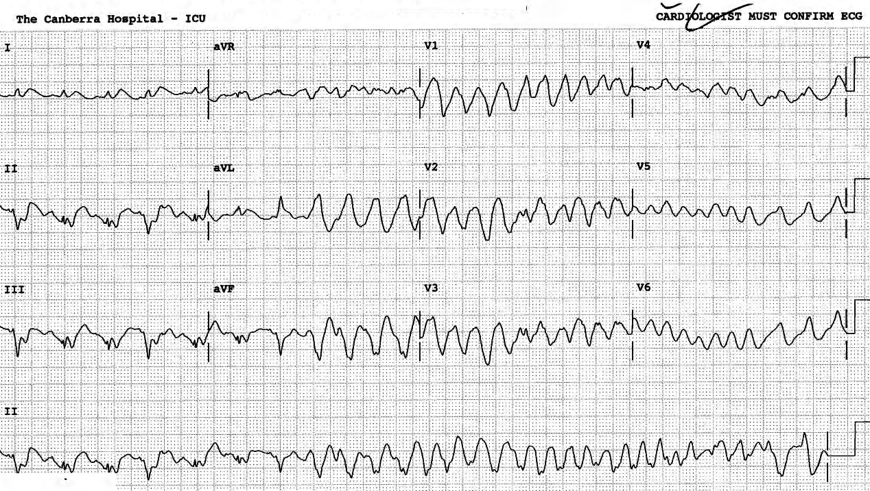 69 year old man transferred, intubated, after about 40 countershocks in CCU, to ICU, where he had another 30 before he died. 