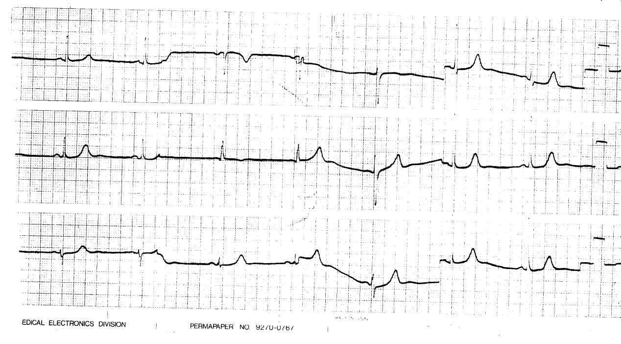 Sinus bradycardia. Perhaps chronotropic incompetence should be a contraindication for nitroglycerin?