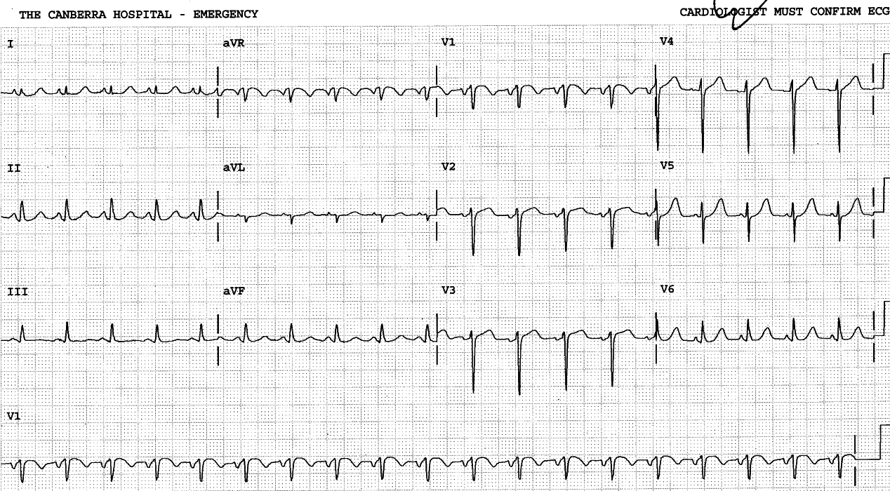 45 year old man with recurrent pulmonary Ådema, cured by IV metoprolol.