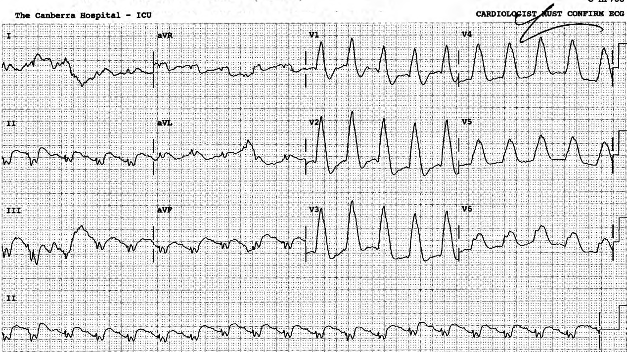 Earlier ECG in sinus tachycardia, with RBBB tombstones. 