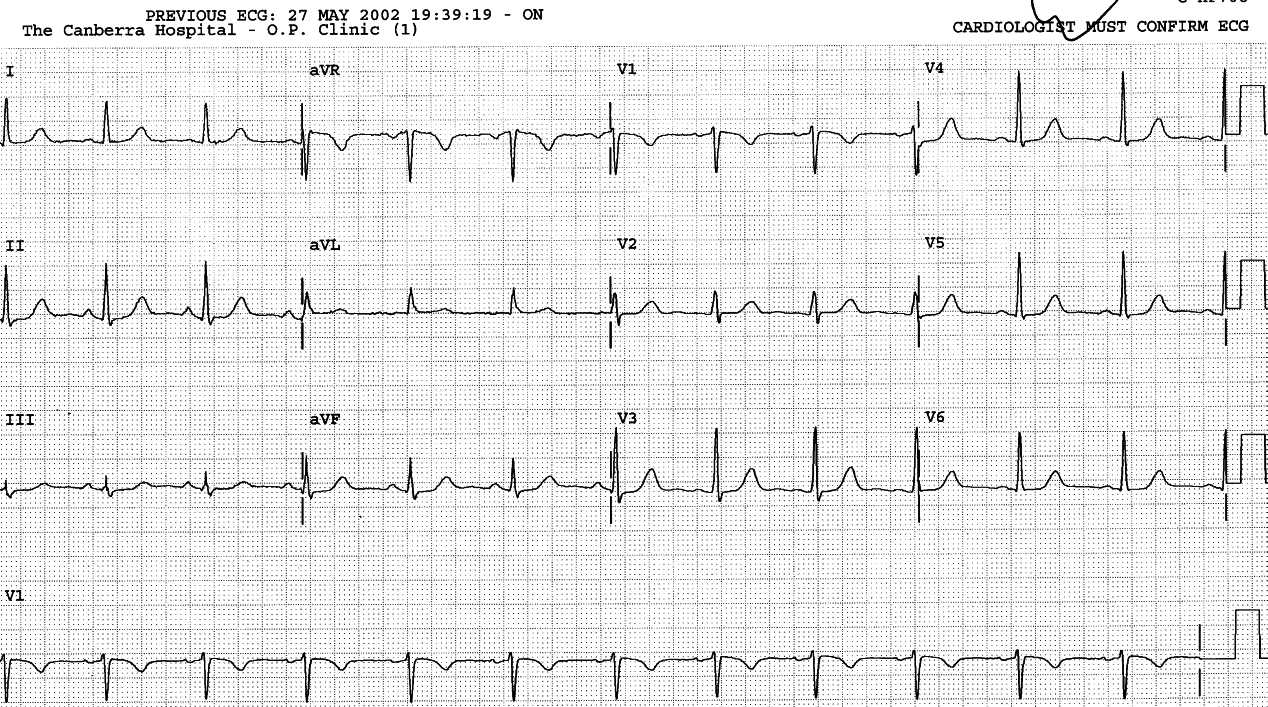 Normalised ECG.