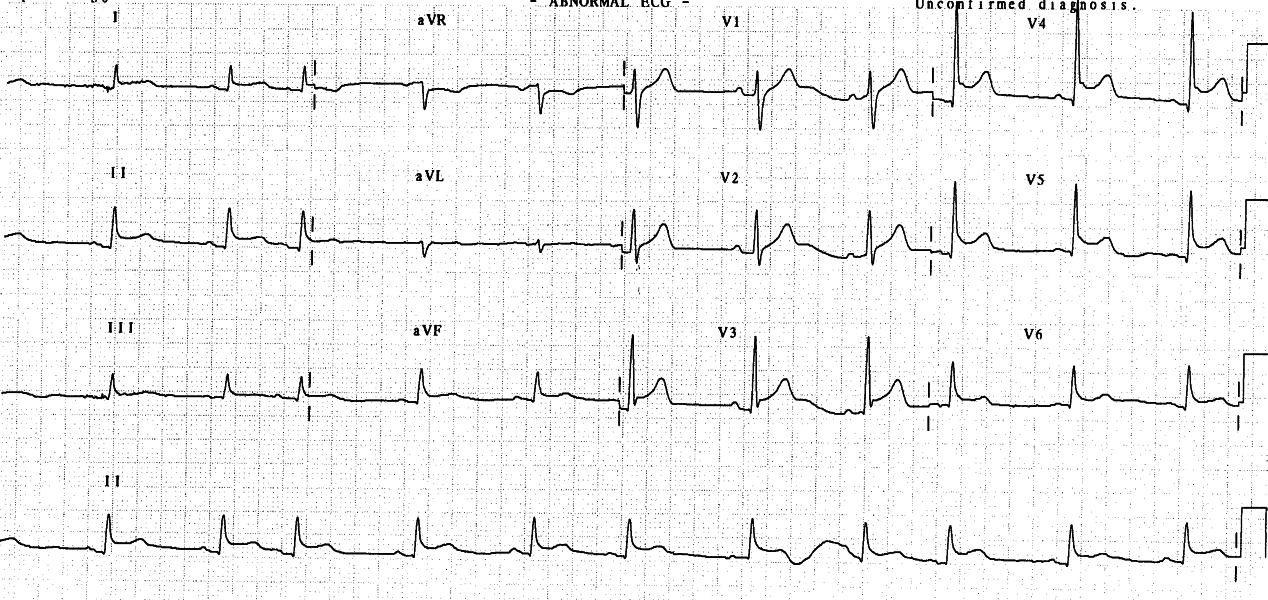 76 year old man in dialysis unit complaining of severe chest pain