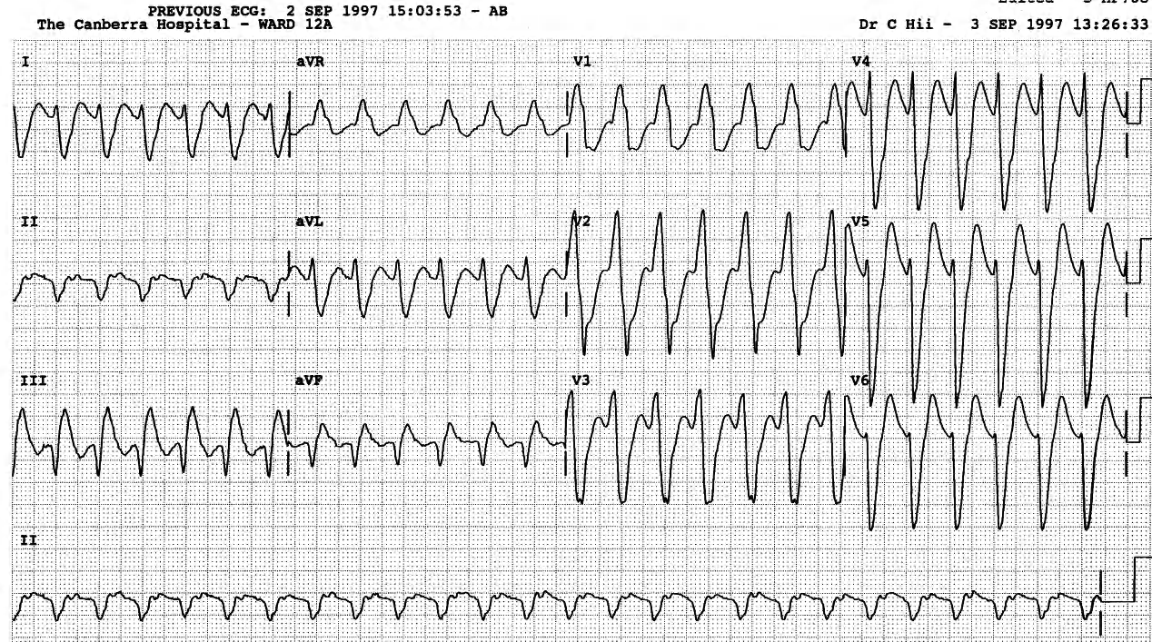 88 year old patient with permanent pacemaker and ischÃ¦mic cardiomyopathy.  