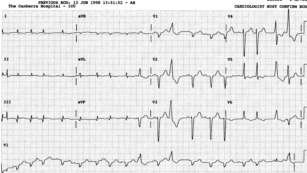 A SVEB (7th complex) starts a short run of bigeminy in the middle of the trace: the rule of bigeminy: bigeminy begets bigeminy. 