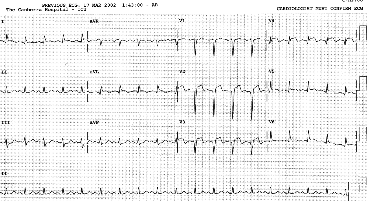 Evolving AMI, 7 hours after Fig 51c, in ICU.