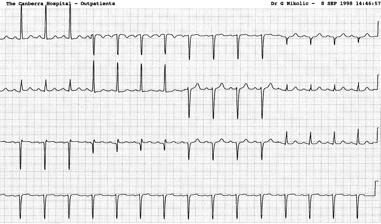 53 year old lady in Cardiology Outpatients. She had several myocardial infarctions in the past