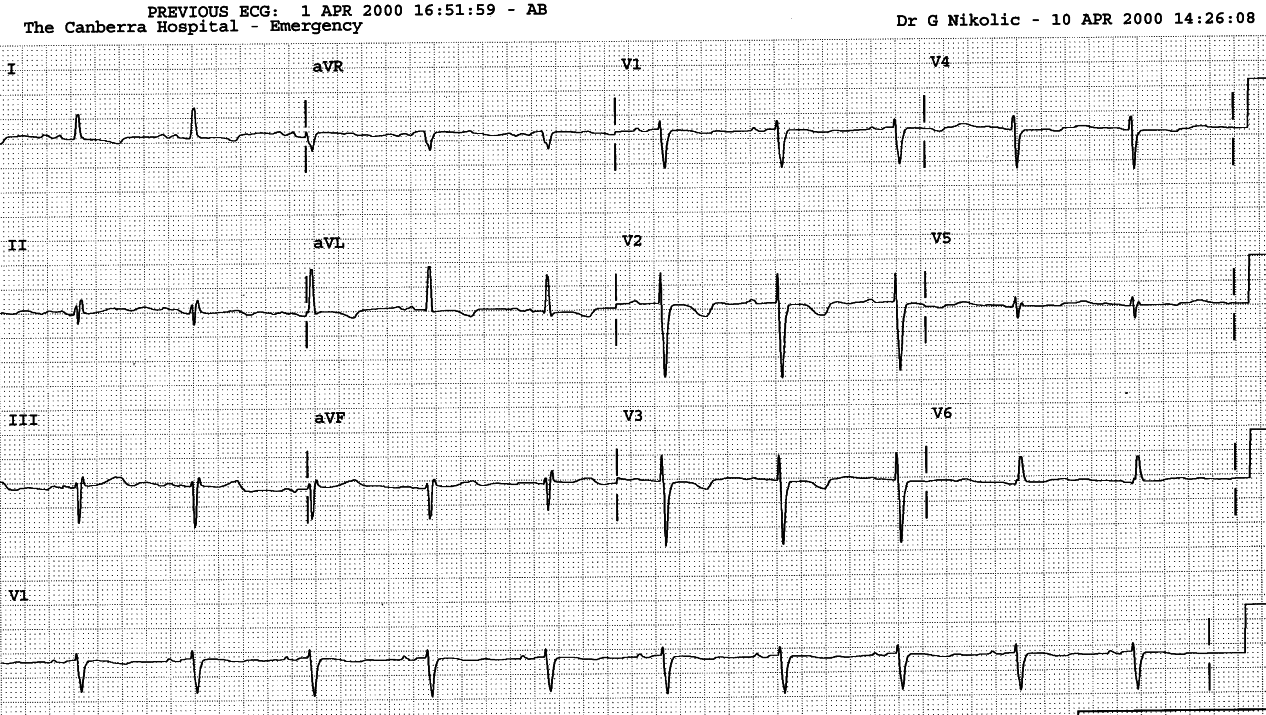 22 year old lady with history of multiple procedures     for tricuspid atresia.  