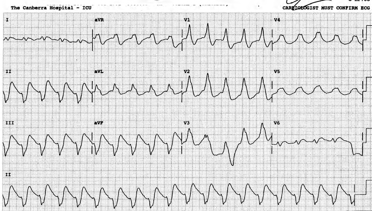 Evolving infarction, two hours after recording in Fig 103b. There is an LAHB added to RBBB. V4-5 complexes look, prophetically, like volcanoes. 