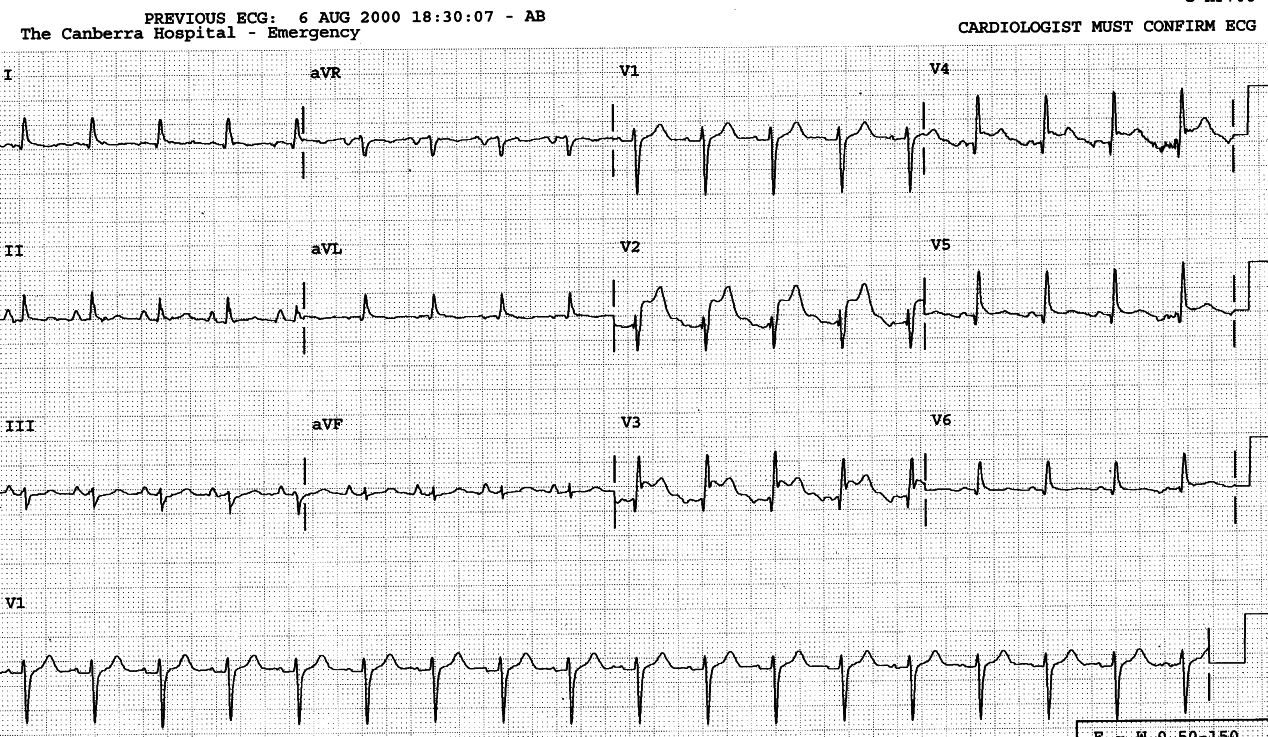 Resolving repolarisation changes in Casualty.