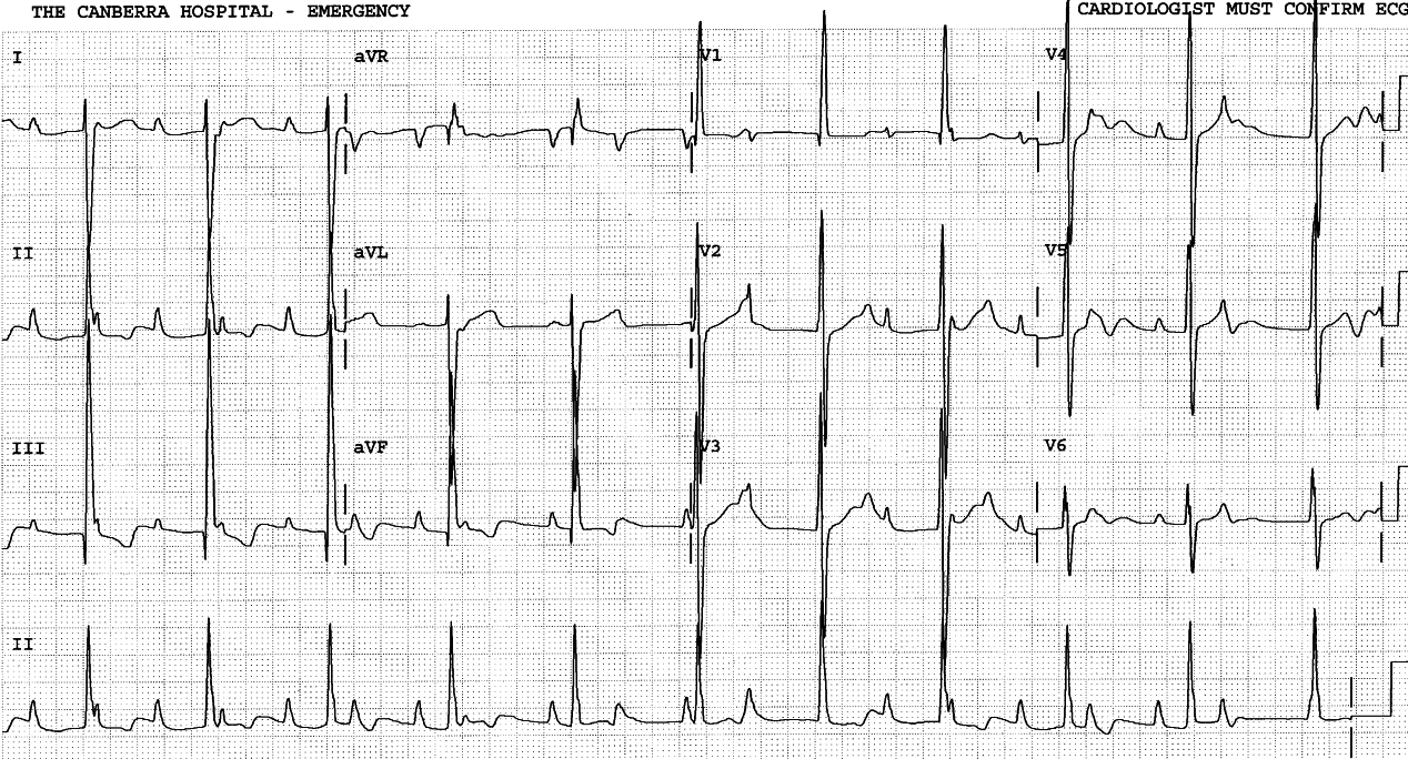 Intermittently cyanosed 3 year old girl