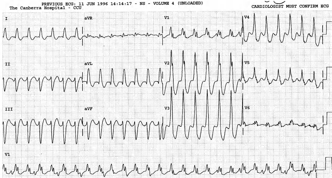 79 year old lady with ischÃ¦mic cardiomyopathy, experiencing left arm pain and dizziness. 