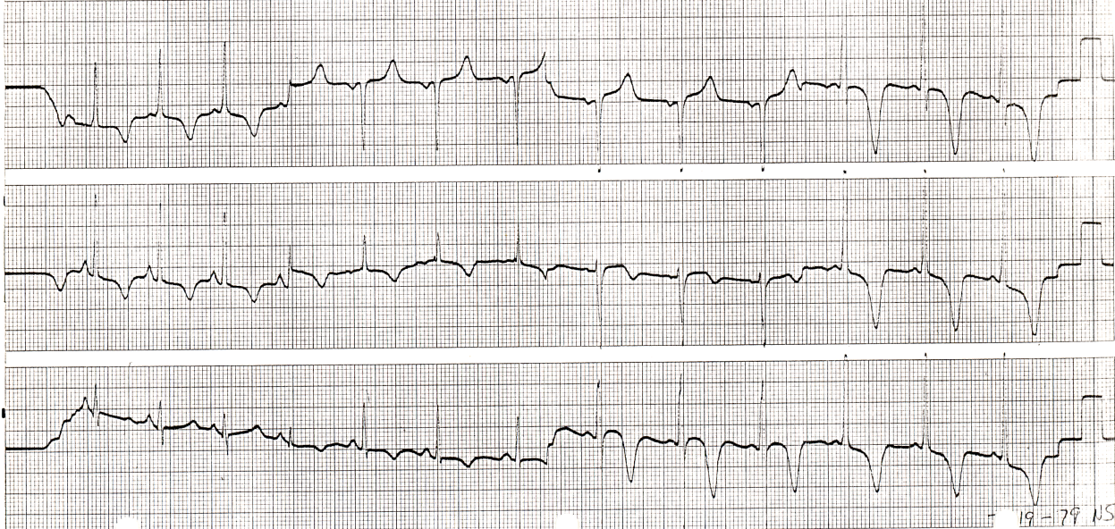 42 year old Negress with no cardiac history or findings. The tracing (lead 2) was taken during carotid sinus massage in the course of a routine postoperative examination for an unrelated condition. Why was the carotid massage performed? 