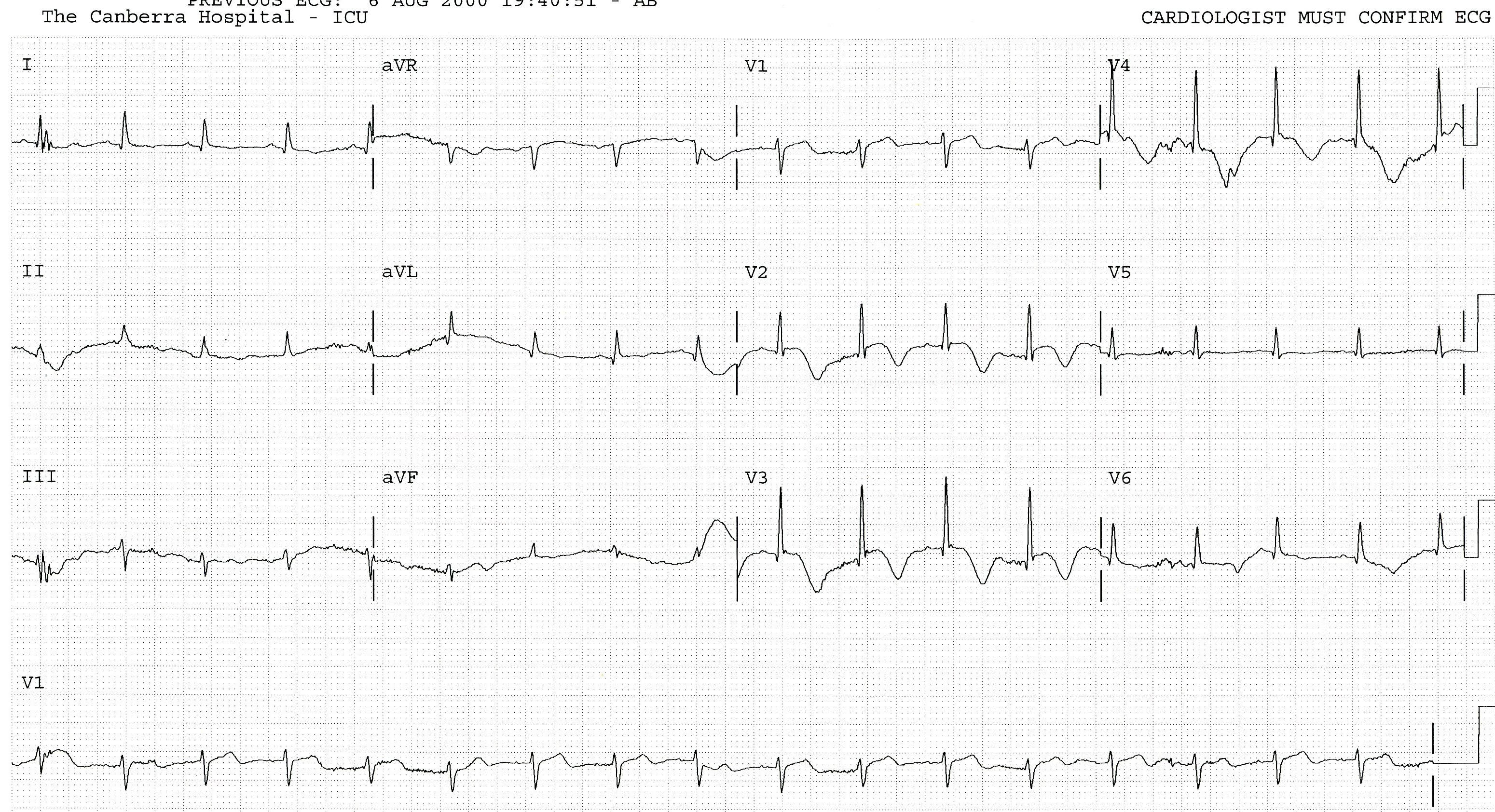 Further resolution of ST segment elevation and inversion of T waves. The spasm came and went, but the damage had been done.