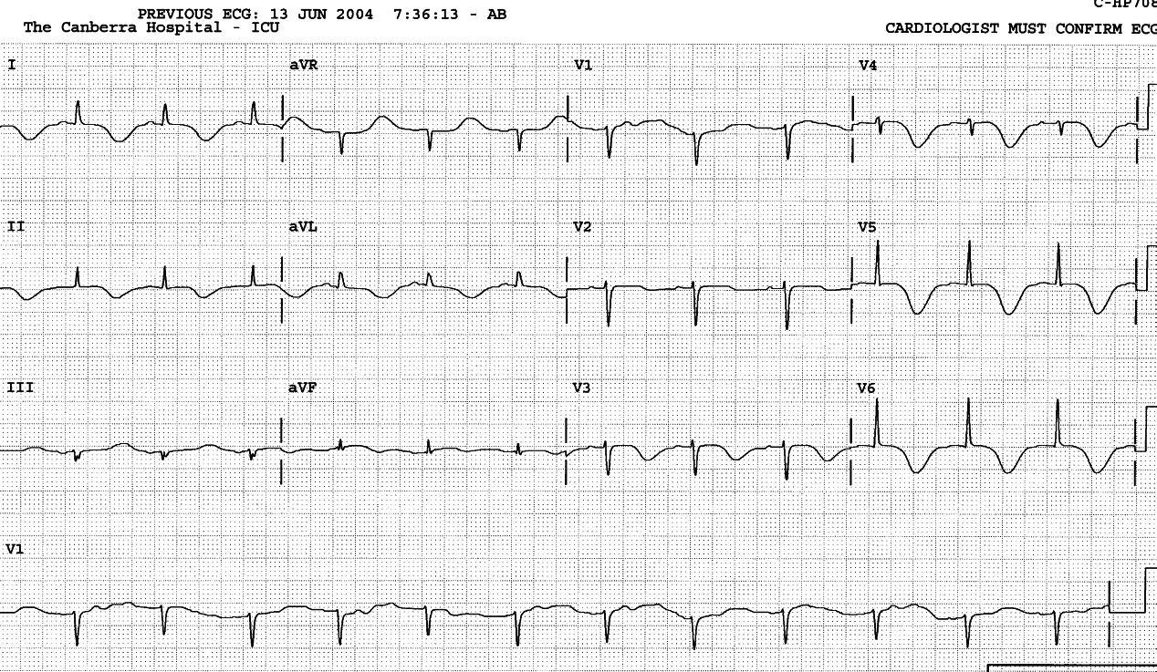 69 year old lady recovering from cardiogenic shock. She has normal coronary arteries