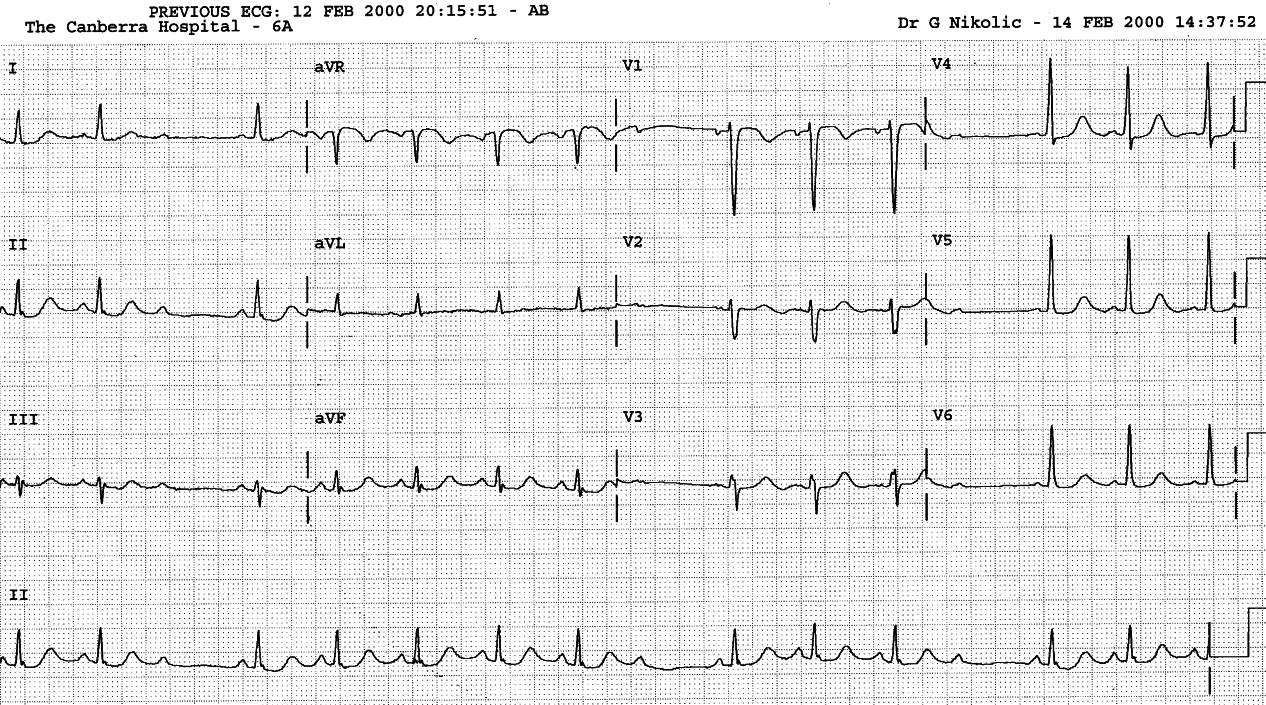 72 year old lady with chronic renal failure and irregular     rhythm. 