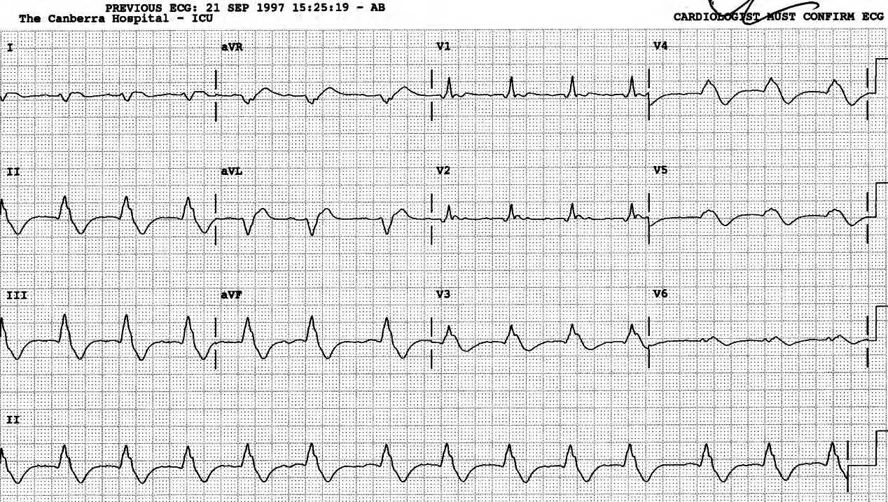 Atrial rhythm, possibly sinus, with RBBB and new LPHB. 