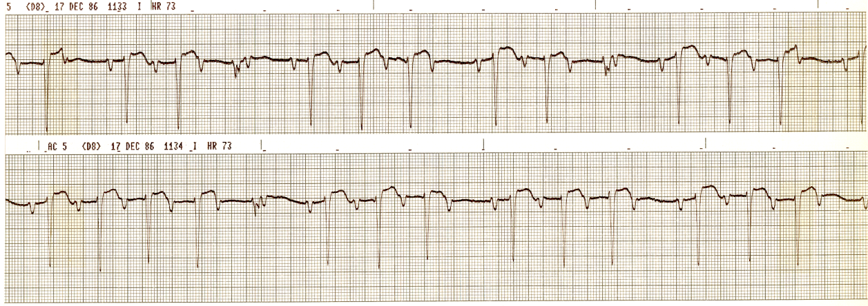 There is LVH with striking T wave inversion and RAA. 