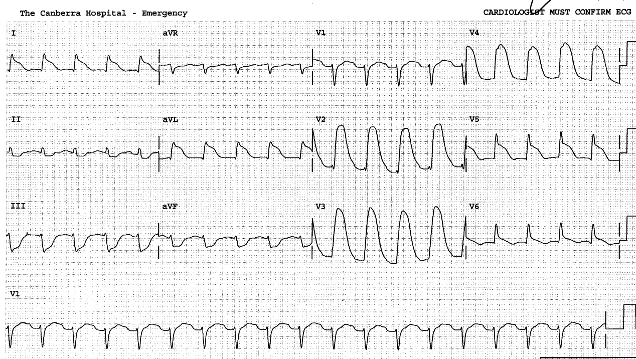 44 year old man, this one with fixed LAD artery obstruction.