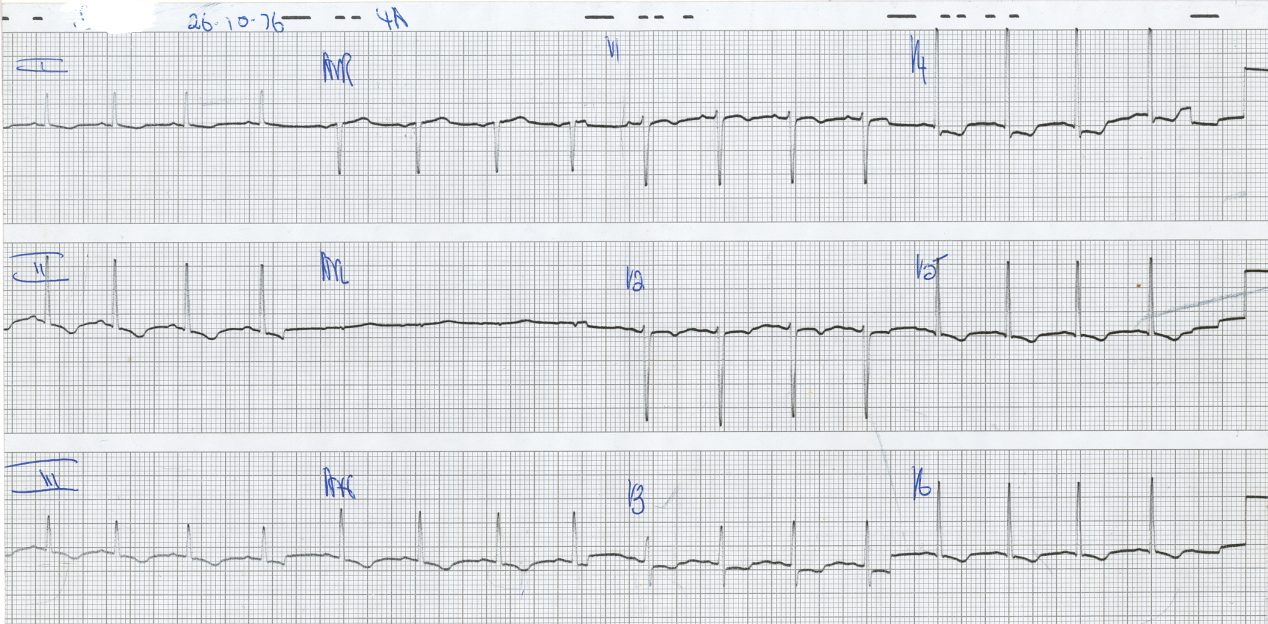 28 year old lady with tachycardia and chest pain on admission. She had been taking liberal doses of pseudoephedrine for sinusitis