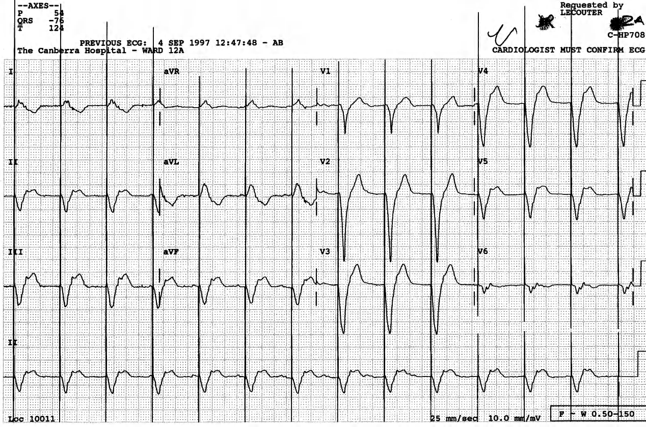 Pacemaker rhythm. Lead 2 retains the pseudo-retrograde-P waves. The negative concordant pattern is not uncommon in pacemaker rhythms. 