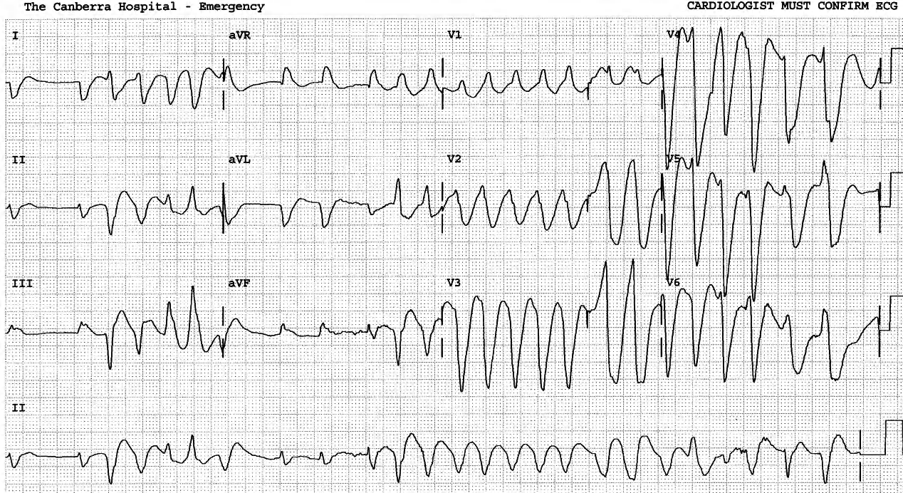 55 year old man with severe chest âtightnessâ for the past hour. 