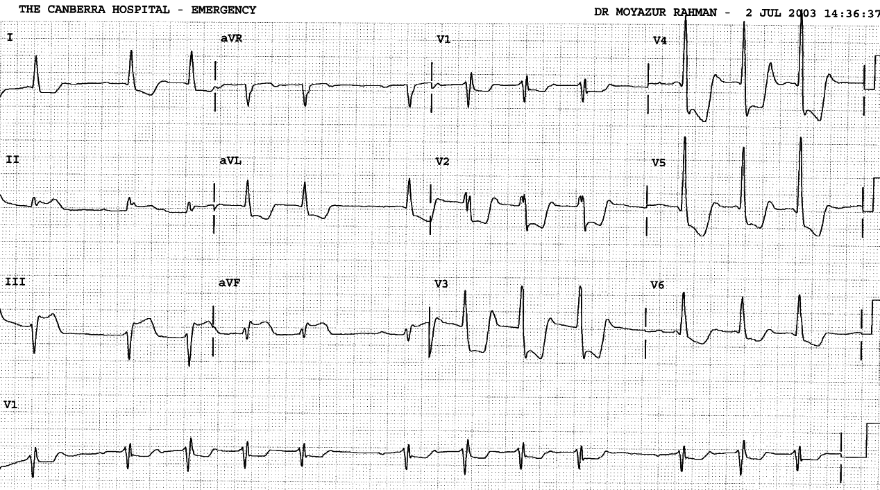 81 year old man with chest pain.